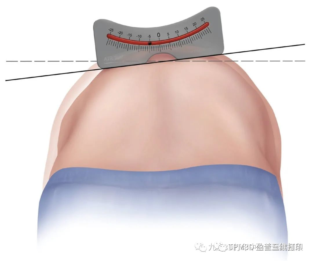 脊柱側(cè)彎檢測