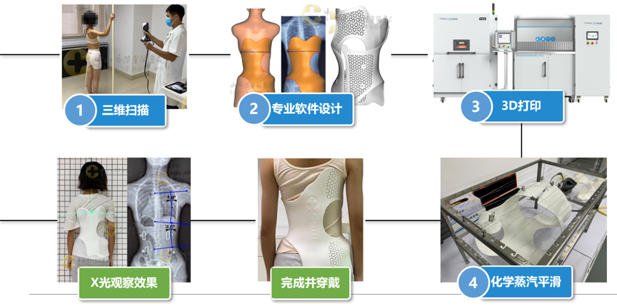 SLS 3D打印脊柱側(cè)彎矯形器制作流程